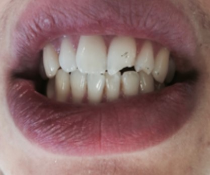 Upper and lower decay Teeth show unhealthy