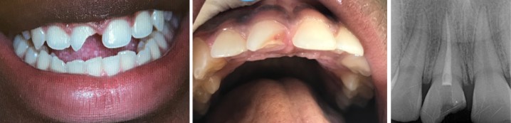 Intra oral view of missing tooth