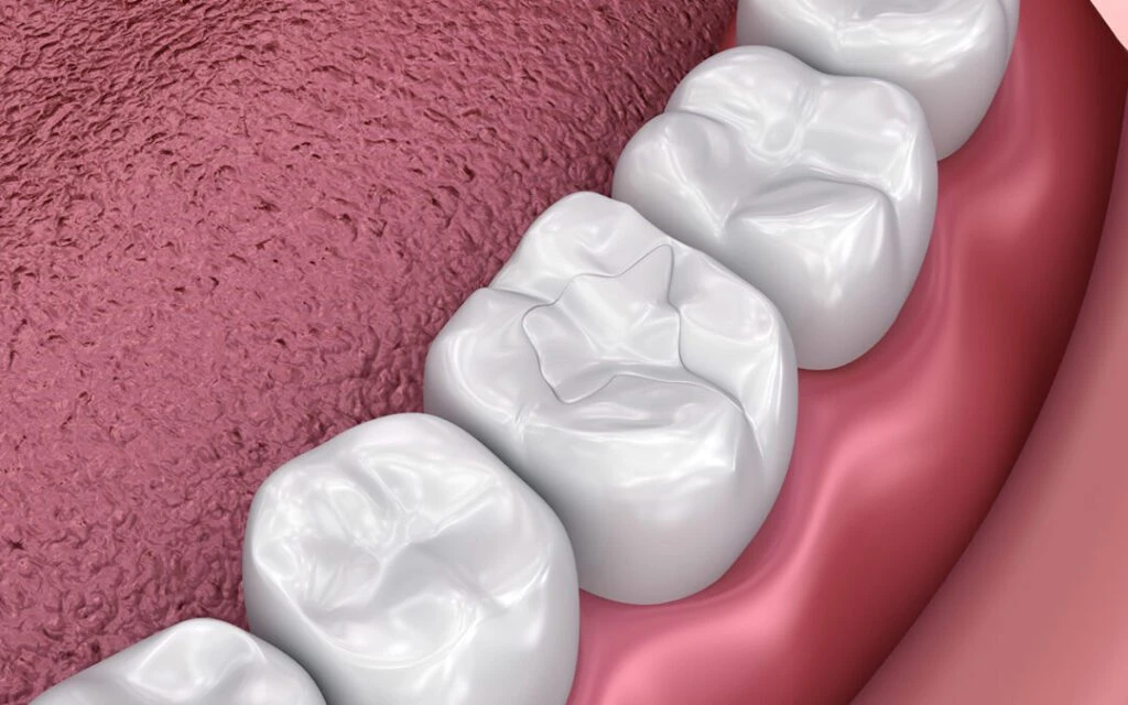 dental-filling